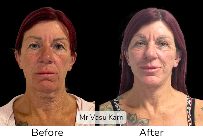 Facelift Patient 3 View 1